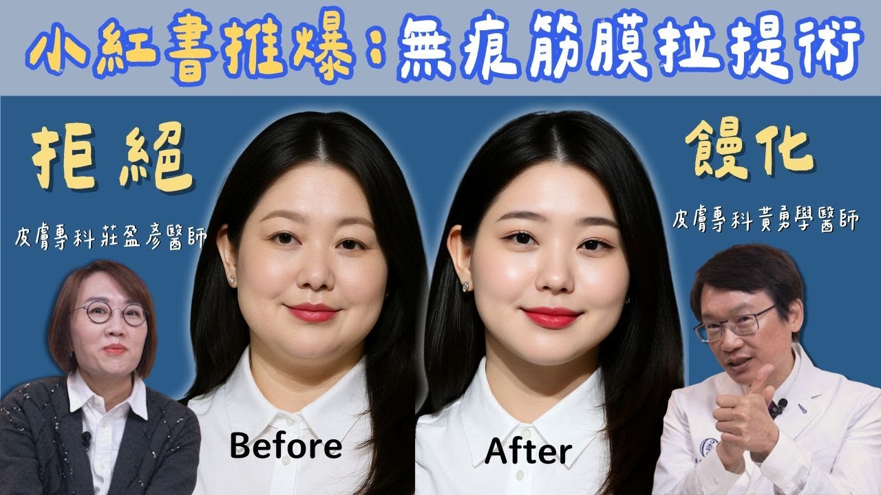 無痕筋膜拉提術是真的！拒絕饅化臉！微整形權威黃勇學醫師告訴你三個秘訣！