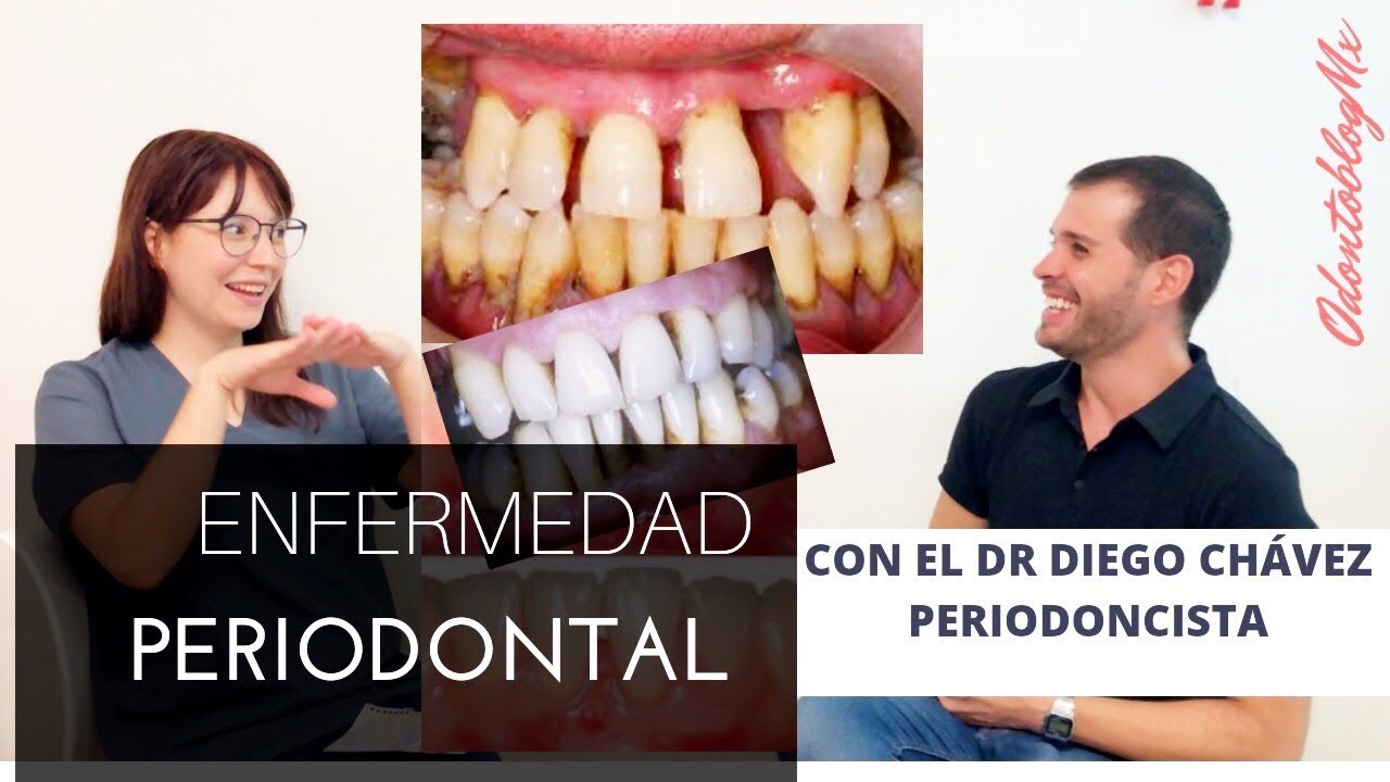 TODO SOBRE la Enfermedad Periodontal con Dr. Diego Chávez