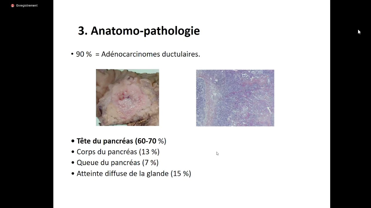 #Gastro 33.Cancer du pancréas