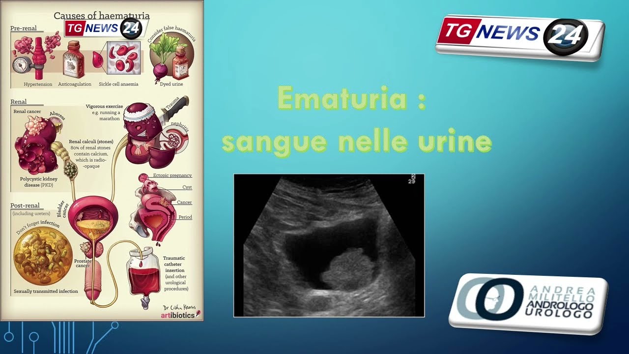 Il sangue nelle urine, la micro e macroematuria. Urologo a Viterbo.  TGNews24 Viterbo