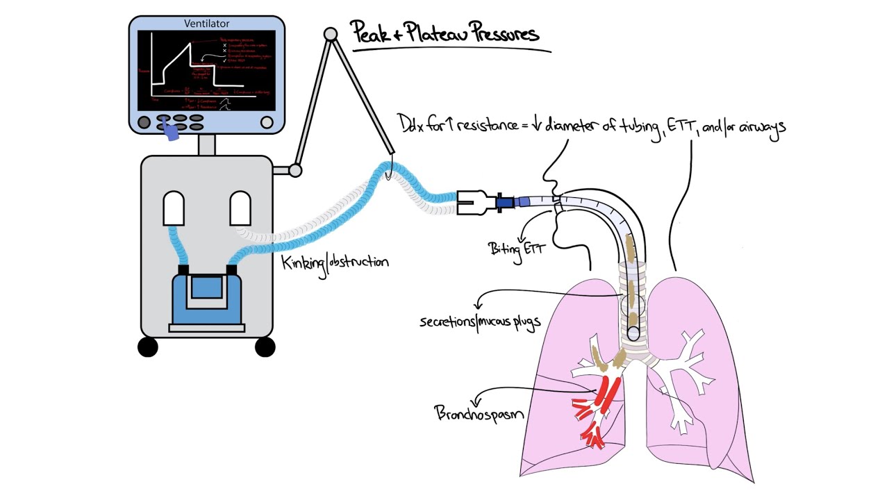 Chalk Talk: Peak & Plateau Pressures