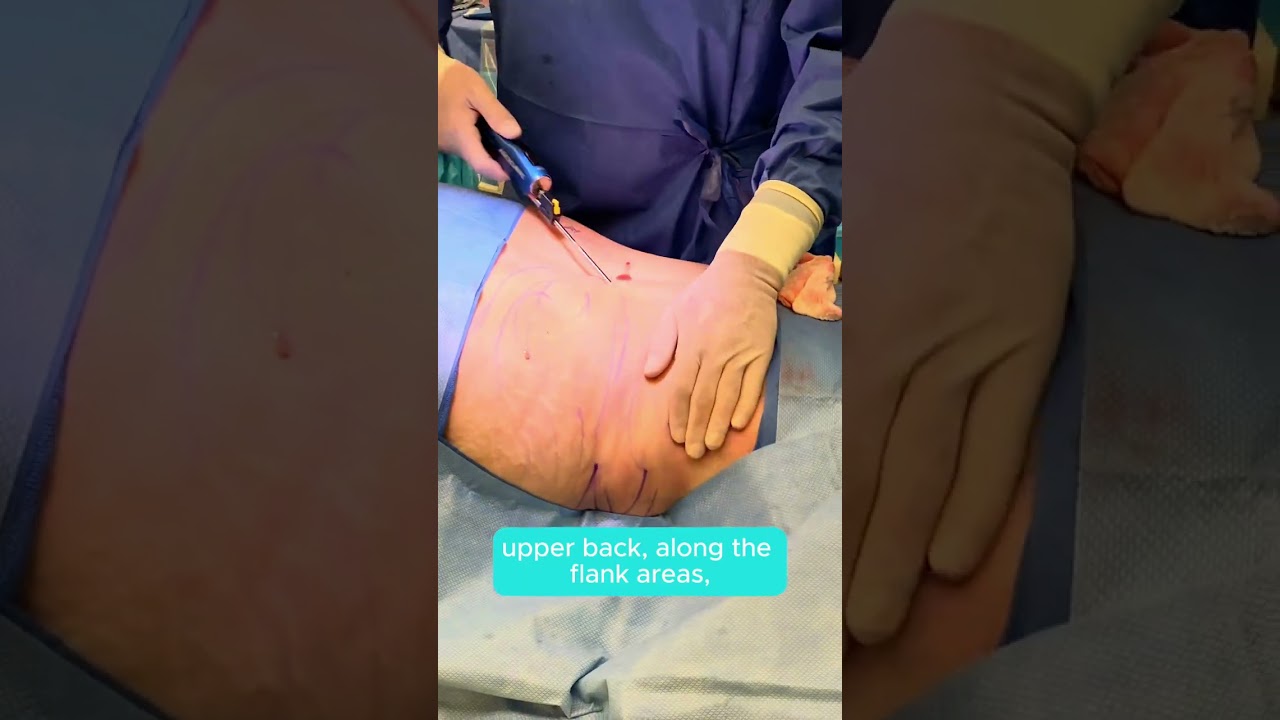 Can you combine liposuction & tummy tucks?