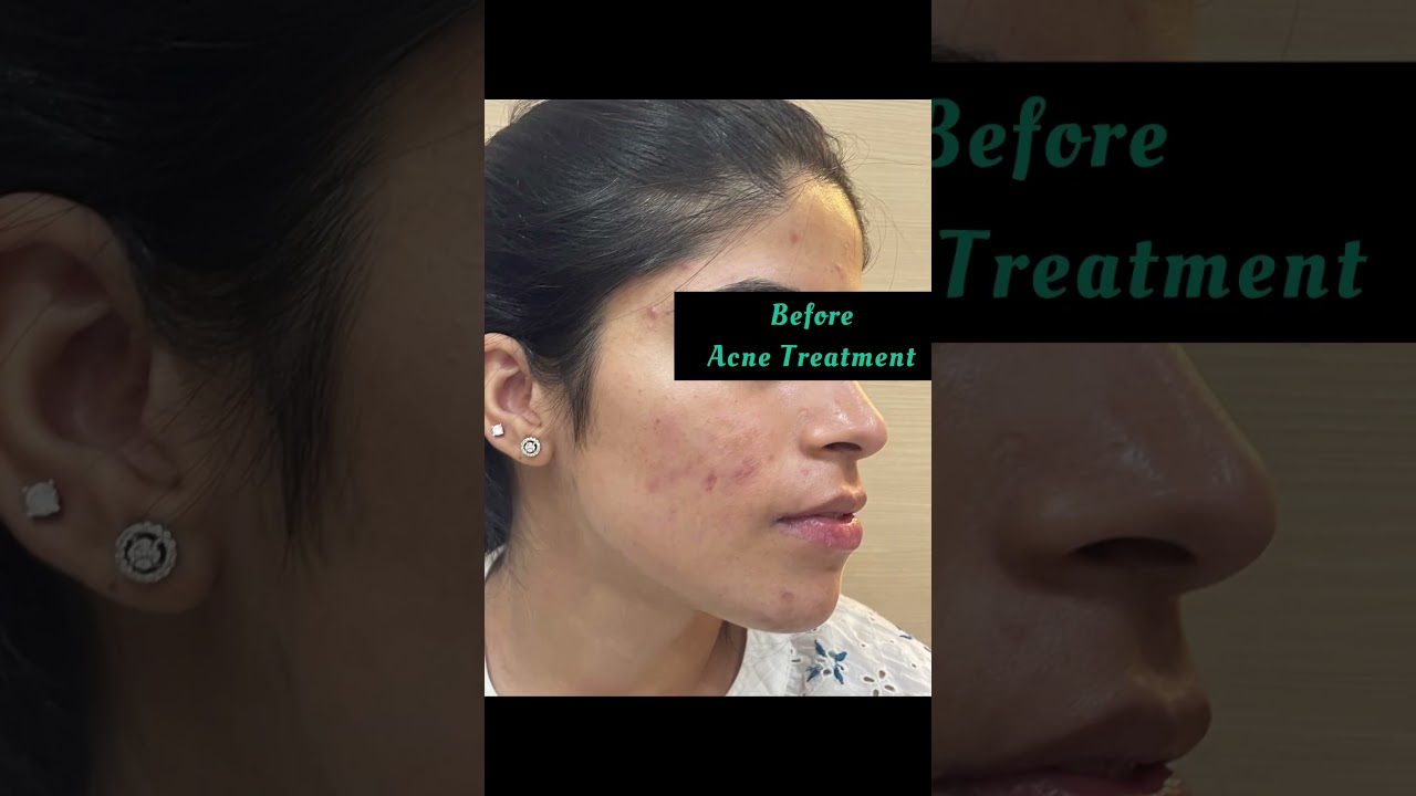 Best acne treatment in Punjab|Acne specialist in Punjab 