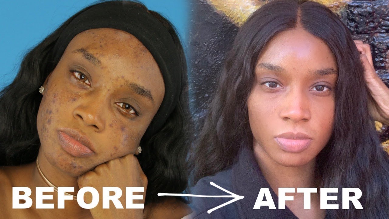 Skincare Routine 2020💦 (Dark Spots & Dark Circles)