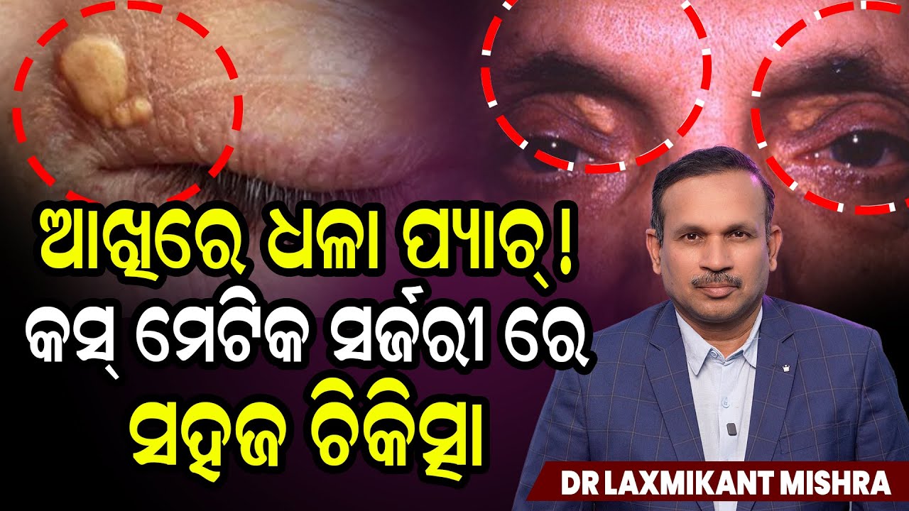 White Patch Near Eyes? Xanthelasma Explained: Causes & Best Treatment!