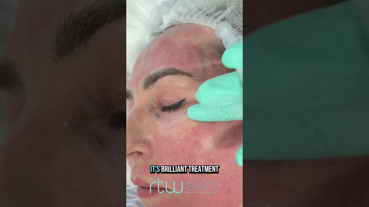 Can Exosomes Really Transform Your Skin? My personal experience.
