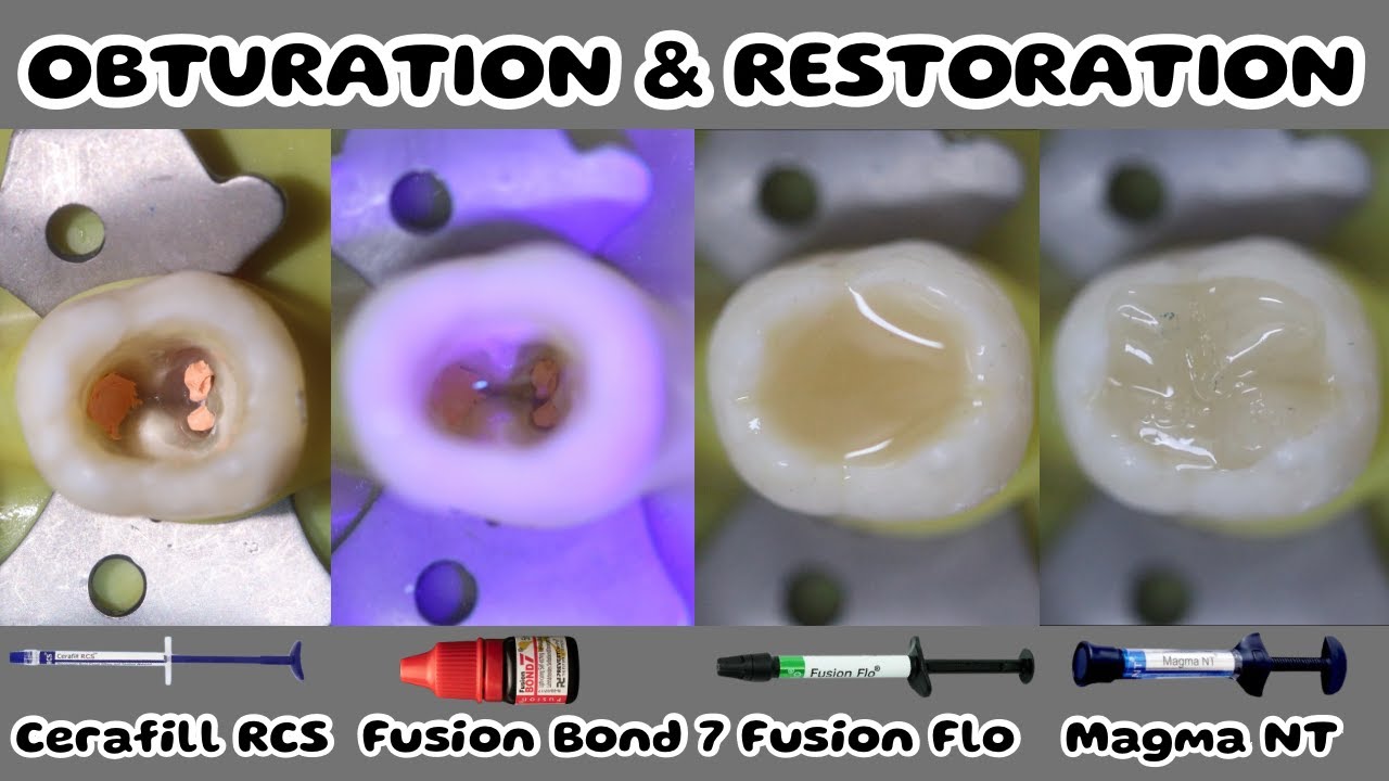 Obturation with Cerafill RCS ⚪️ PostObturation Restoration 🔵 fusion bond 7 🔴 fusion flo 🟢 Magma NT