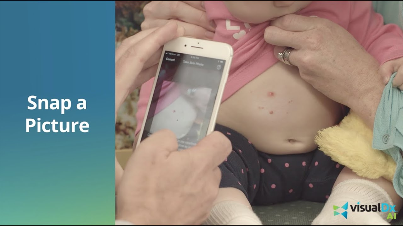 Experience VisualDx AI: Unlock the Power of AI to Support Dermatology Care