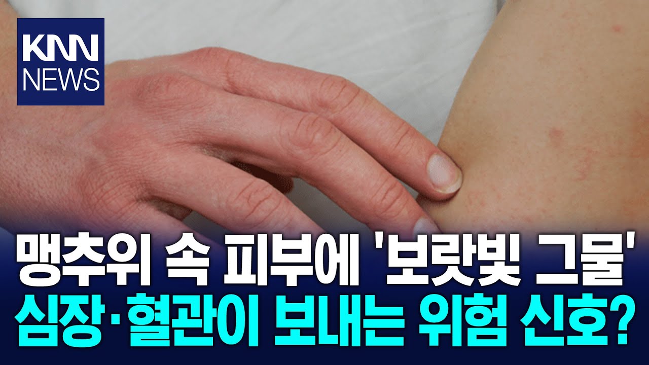 추워서 생긴 줄 알았던 피부 변화 방치하면 혈관 막힌다? '깜짝' / KNN