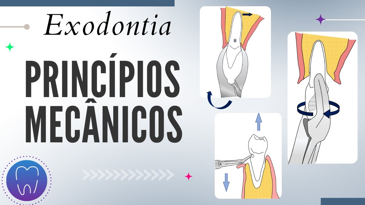 PRINCÍPIOS DA EXODONTIA + TÉCNICA DE EXTRAÇÃO FECHADA | Souza Bru