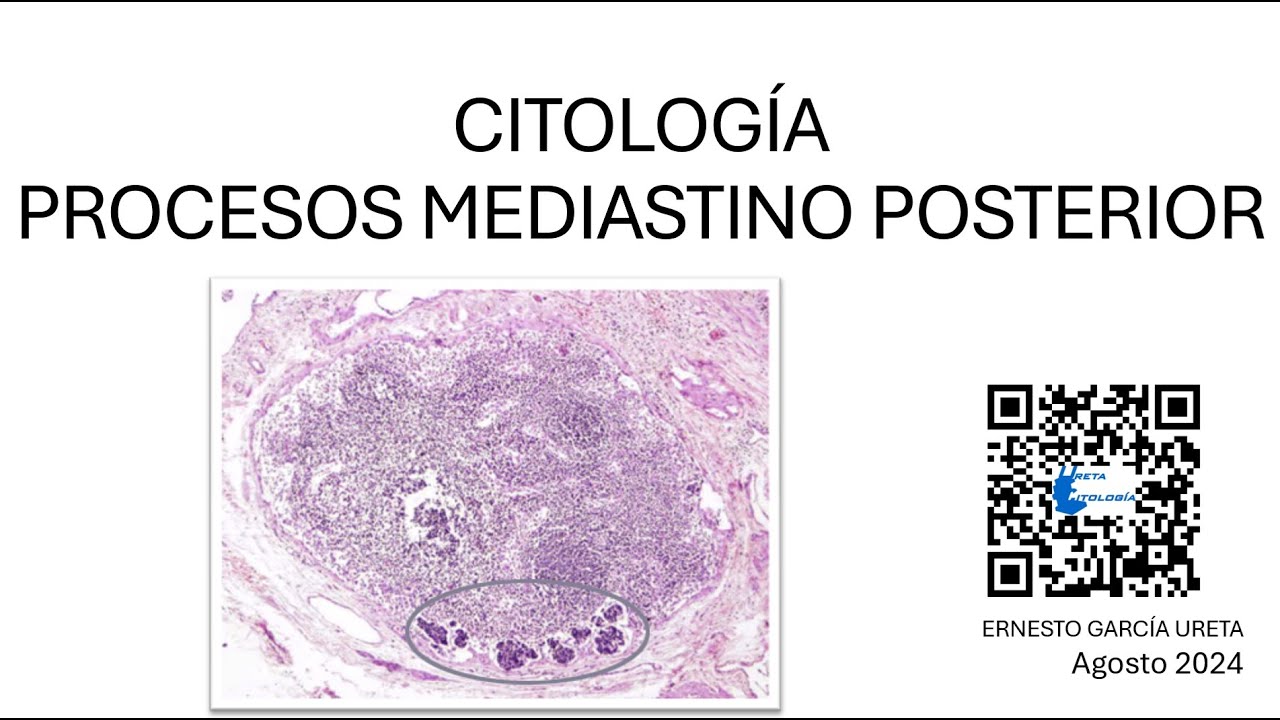 Citología de “Mediastino Posterior”.