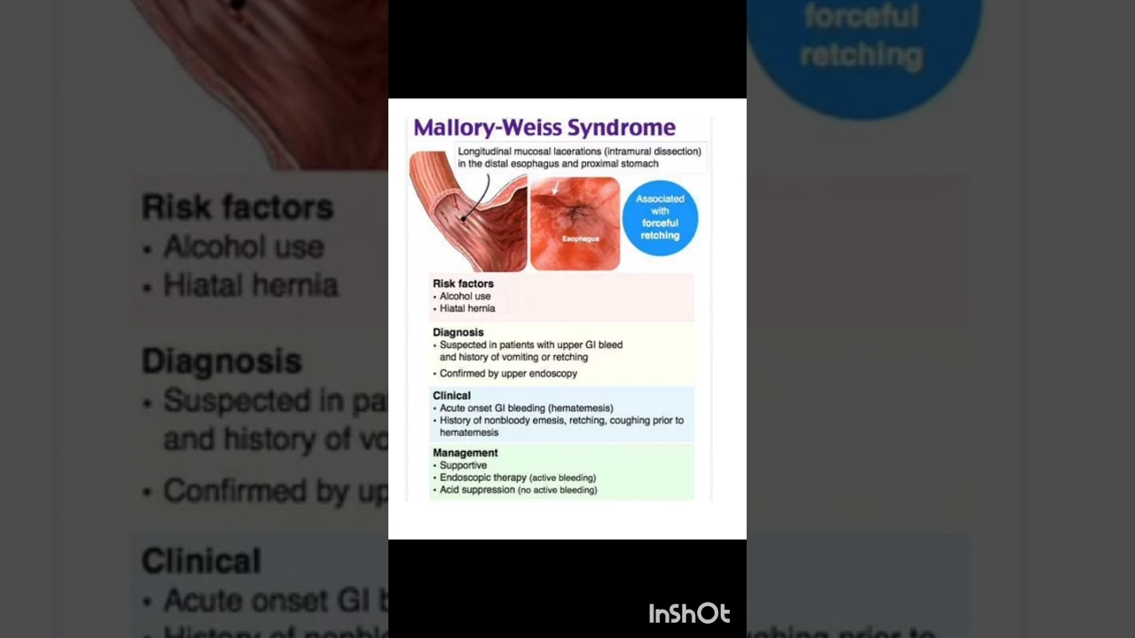 MALLORY WEISS SYNDROME #youtubeshorts #medicallectures