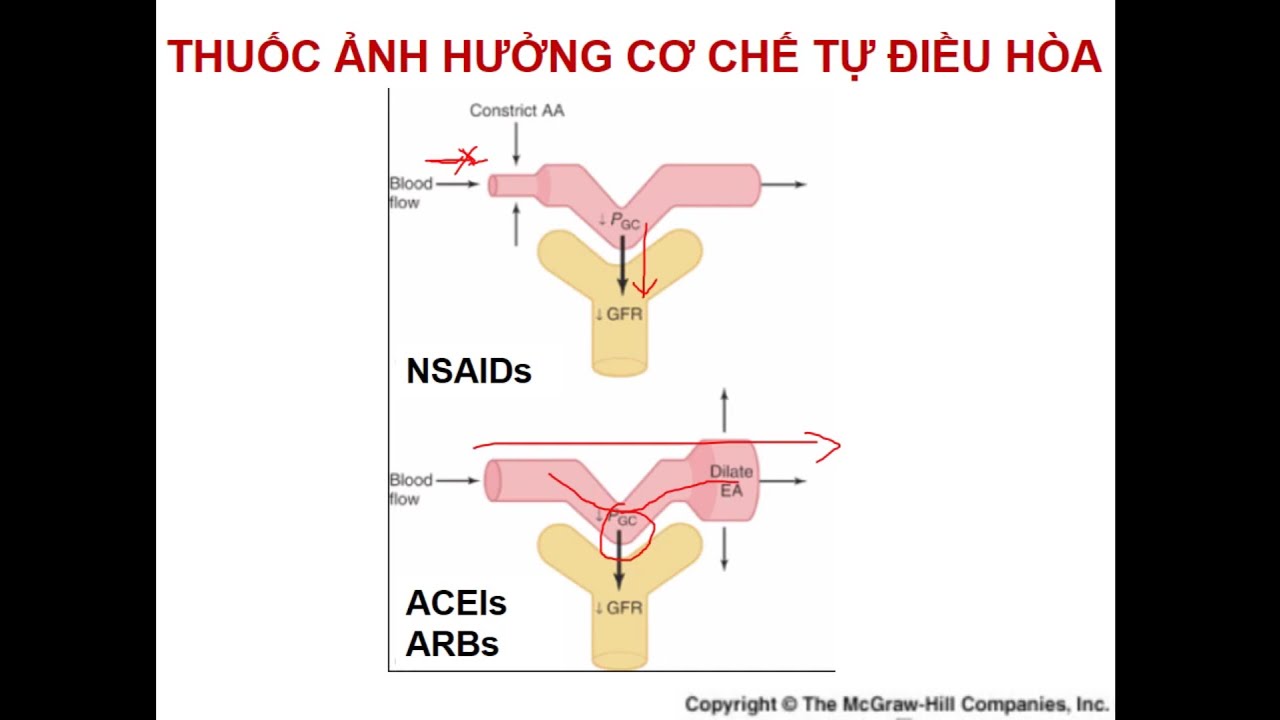 Tổn thương thận cấp | Bs. Nguyễn Sơn Lâm