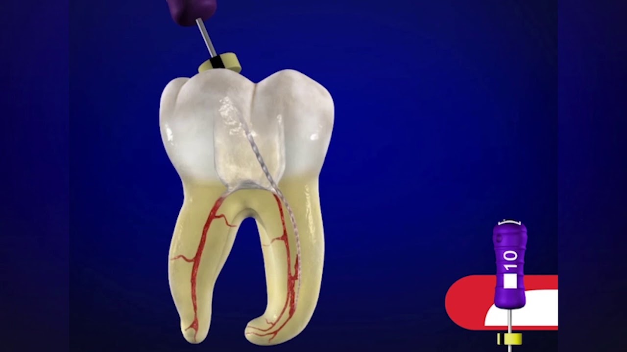 ProTaper Gold&reg; SX file with Dr. Cliff Ruddle  | Dentsply Sirona