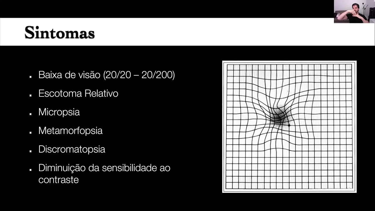 UNIRIO - Coriorretinopatia Serosa Central - Dr. Eduardo Novais (UNIFESP)