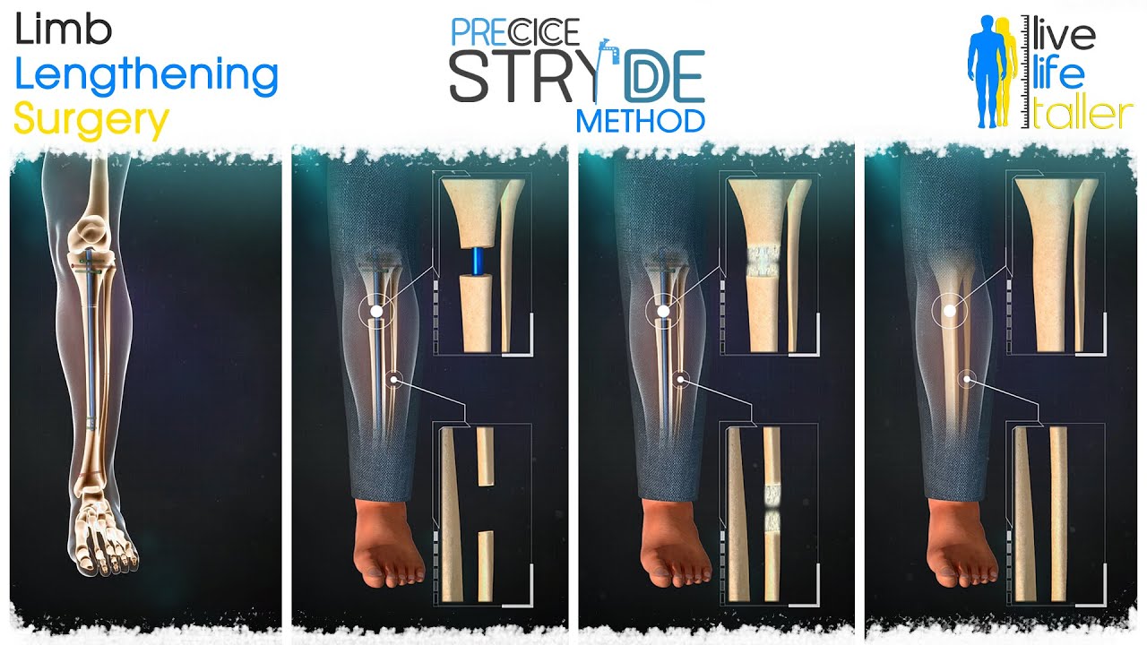 Limb Lengthening Surgery / Precice Stryde Method -  LiveLifeTaller