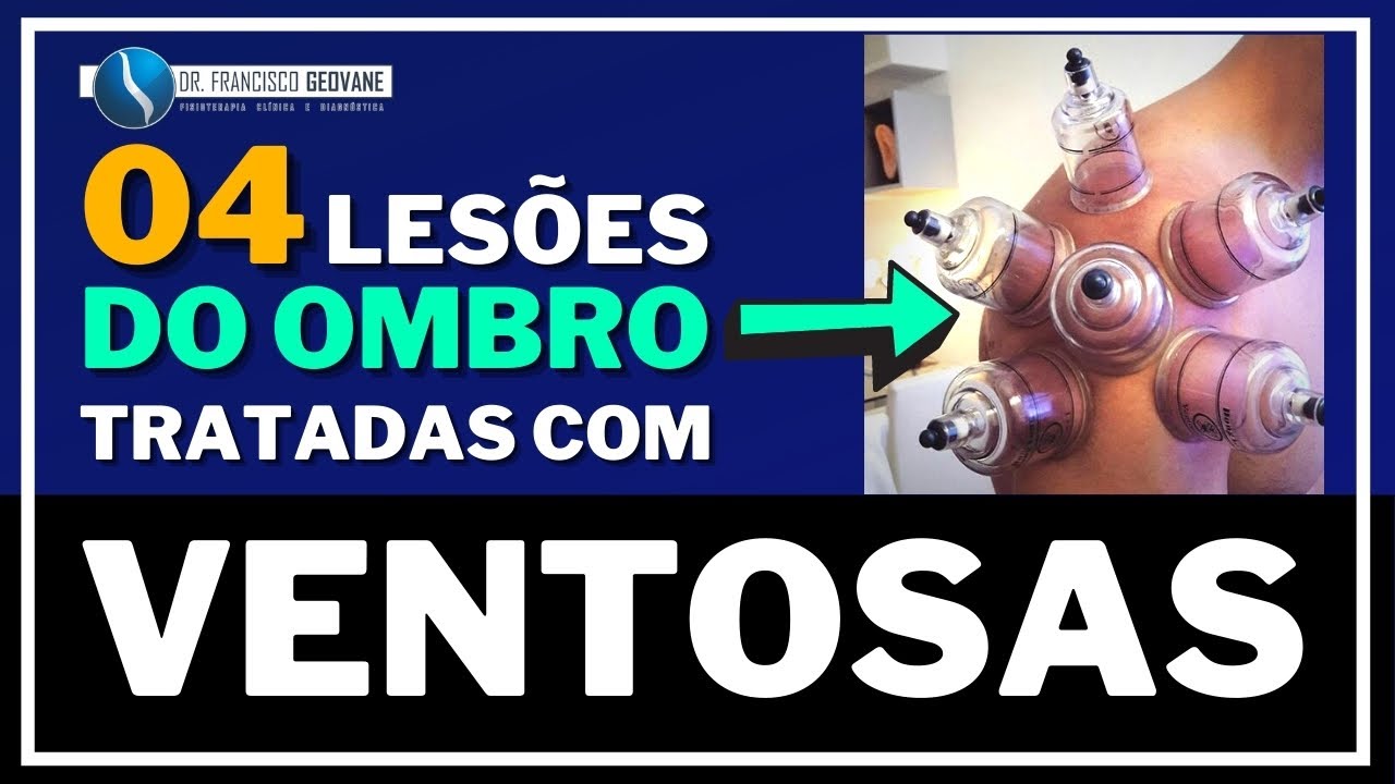 VENTOSATERAPIA - 04 LESÕES NO OMBRO que podem ser Tratadas com Ventosas