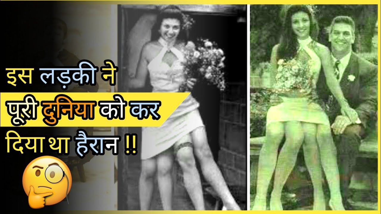 एक ऐसी महिला जिसके पास थे चार पैर | Untold Story of Myrtle Corbin | 