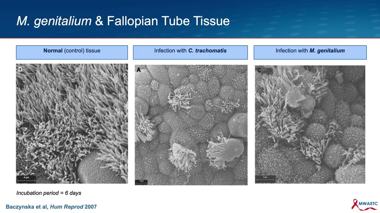 Mycoplasma genitalium