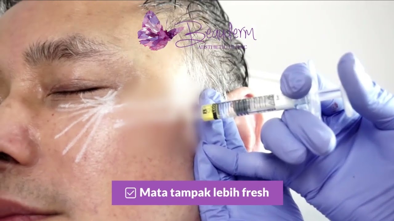 Proses Suntik Filler Bawah Mata (Hanya 15 menit)