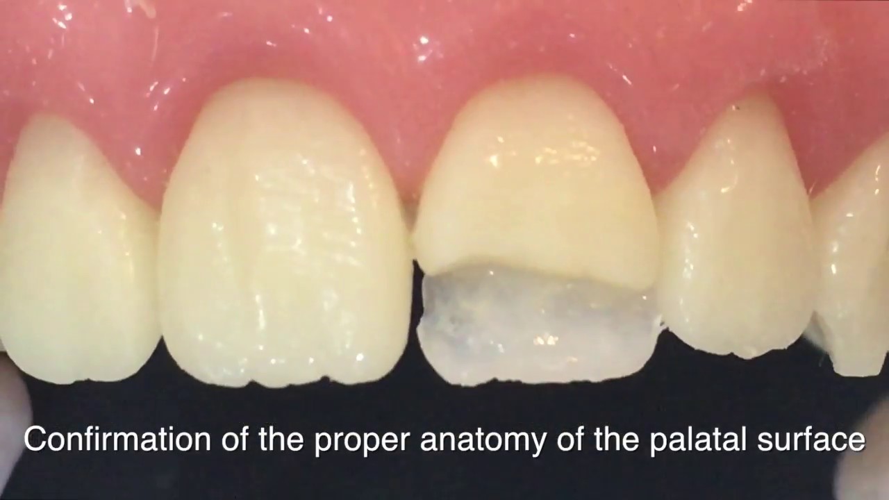 Tips & tricks for Silicone Index use.