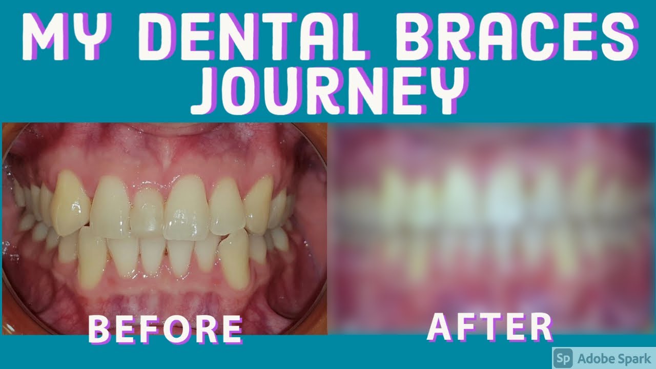 Braces Journey removing my Mesiodens