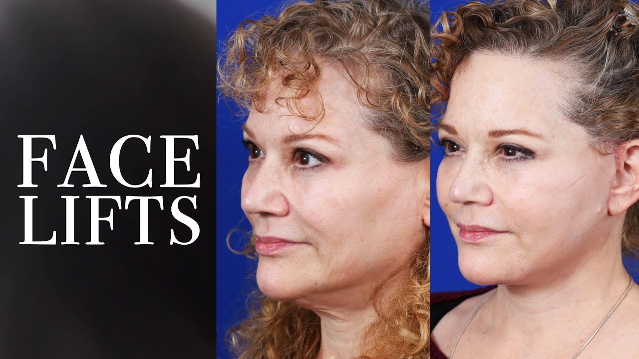 Face Lift Procedure | Look And Feel Your Best | Moustafa Mourad