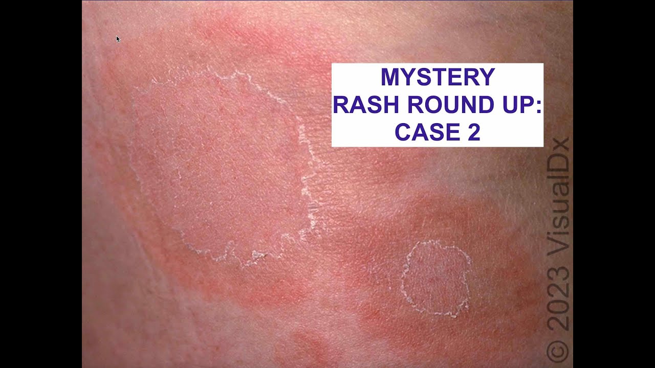 Another Mystery Rash! Use the Skin Exam to Make a Diagnosis!