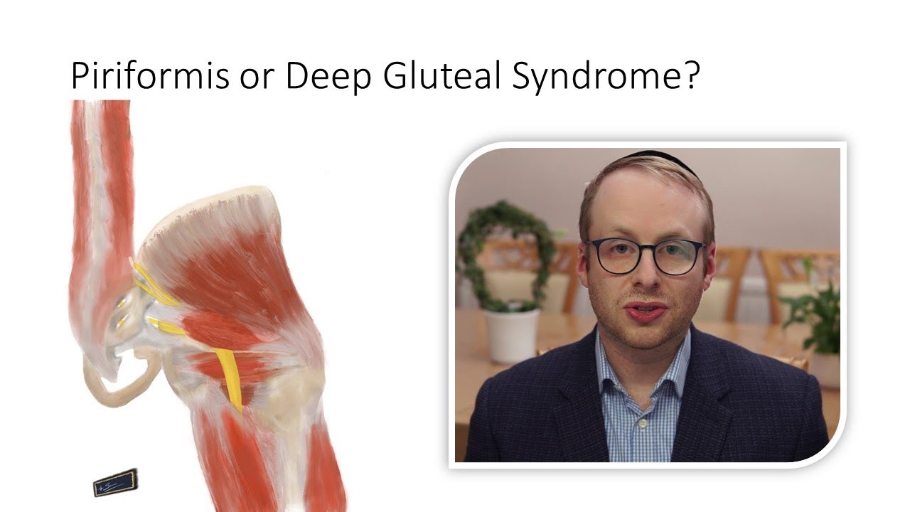 Piriformis Syndrome or Deep Gluteal Syndrome?