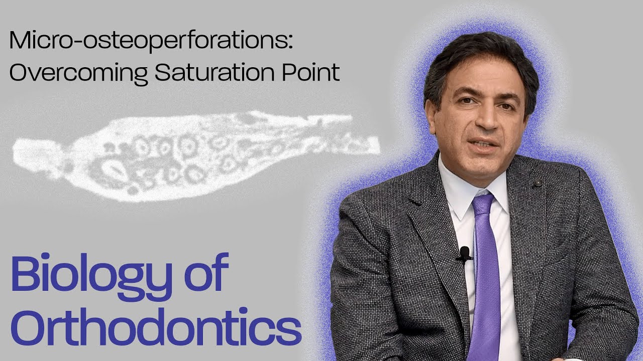 Micro-osteoperforations: Overcoming Saturation Point - Biology Of Orthodontics 