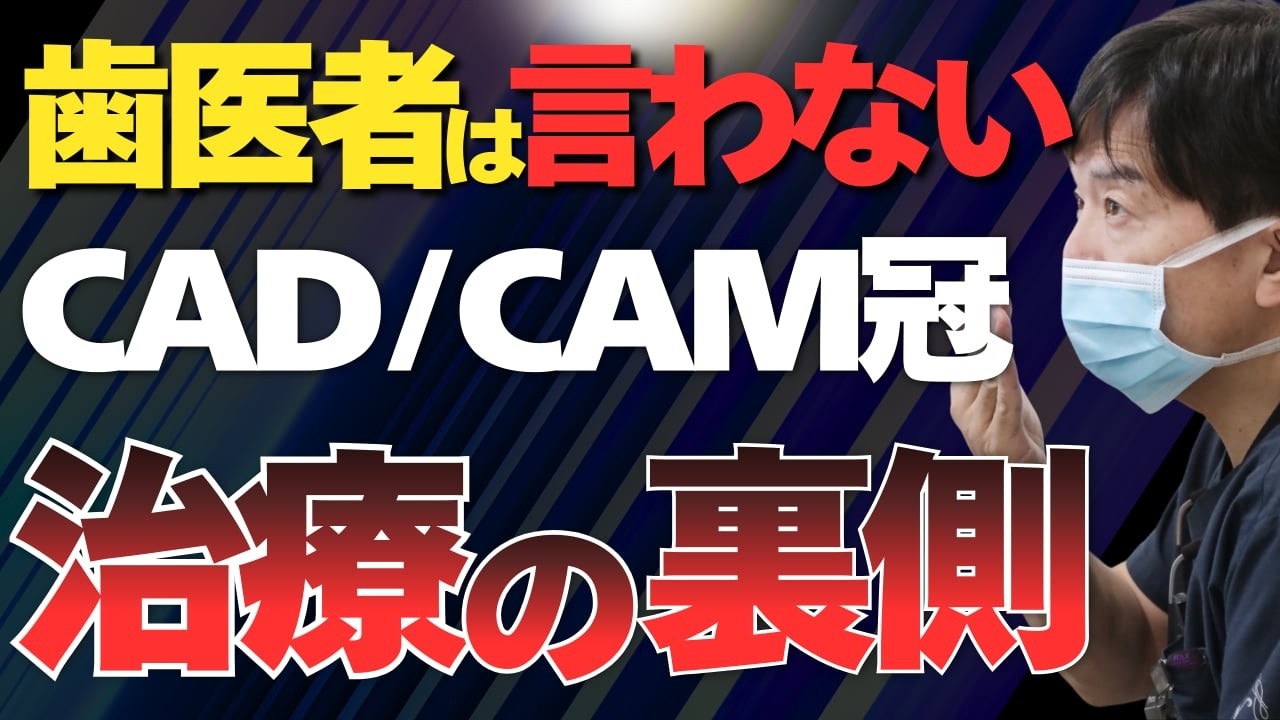 【保険が効く白い歯】CAD/CAM冠を入れる前に知ってほしい5つの事実