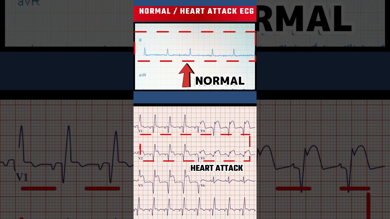 हार्ट अटैक का ECG - HEART ATTACK ECG VS NORMAL ECG#shorts