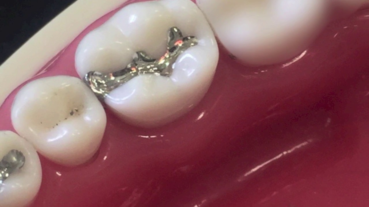 class II amalgam cavity preparation and restoration