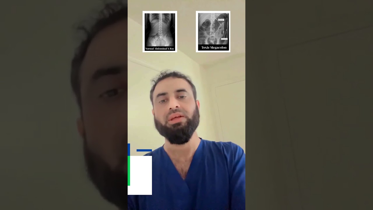 Toxic Megacolon | Exam Key Points | Dr Hafiz Atif | FAME Platform #FCPS #NRE #USMLE&nbsp;#Examtips