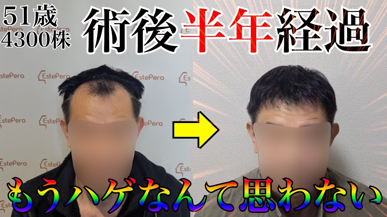 【経過】見た目ハゲと思う人居る？いねぇぇぇぇぇよな！！！