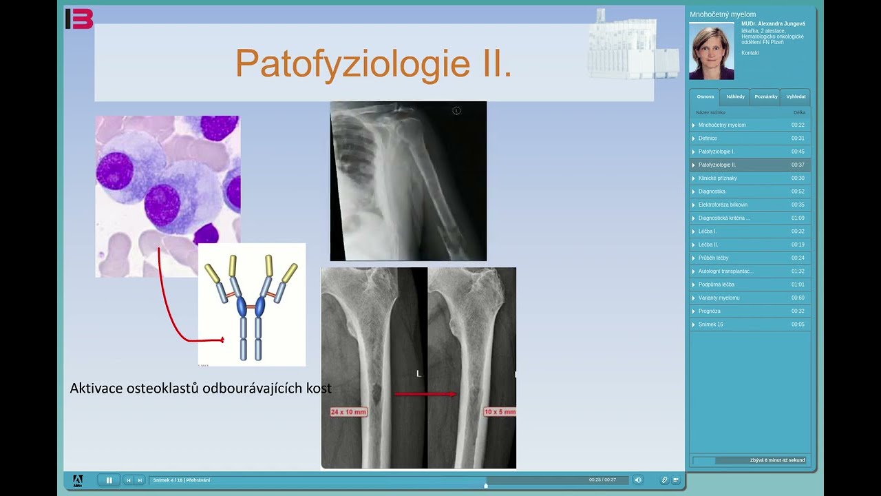 Mnohočetný myelom