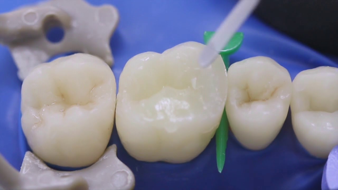 Filtek Bulk Fill Posterior II class