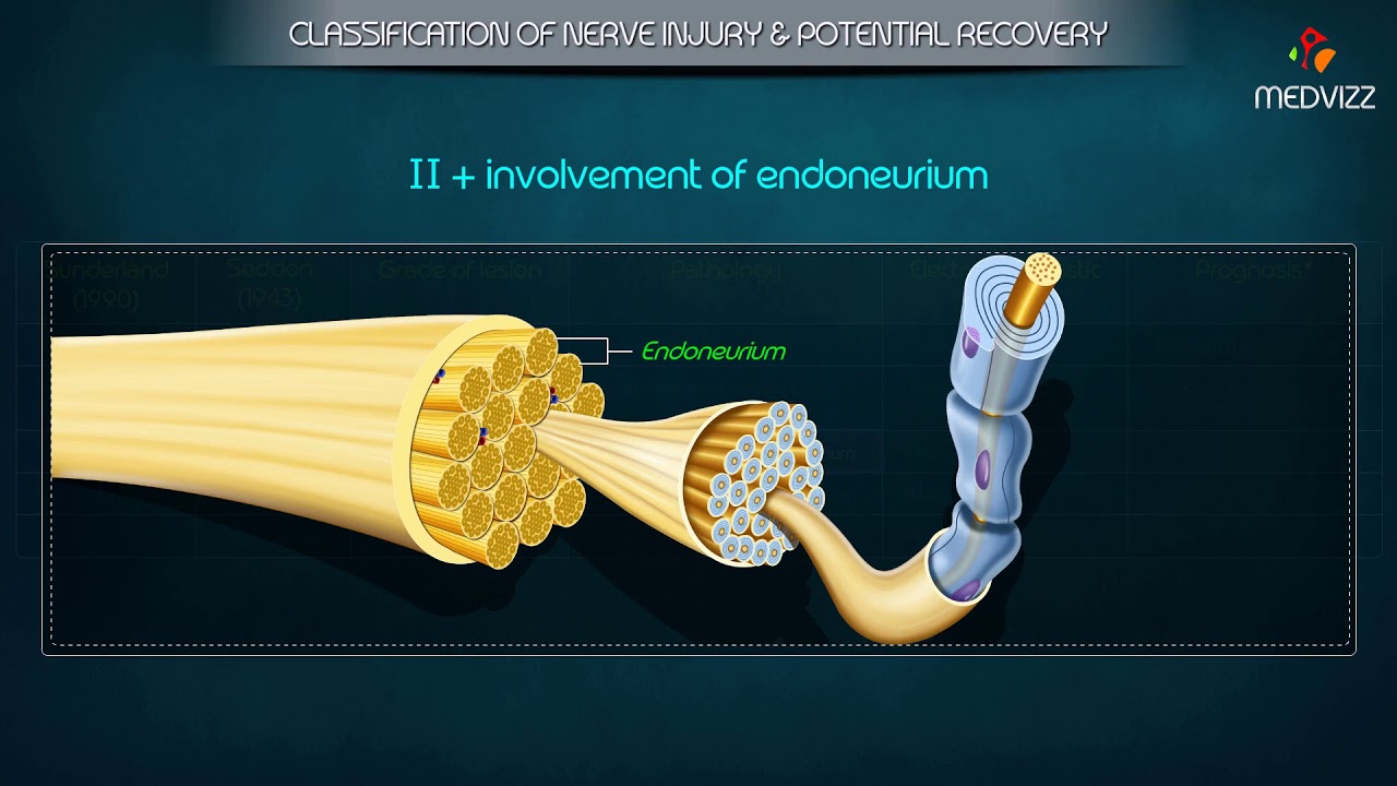 Classification of Peripheral Nerve Injury - Seddon's classification , Sunderland's classification