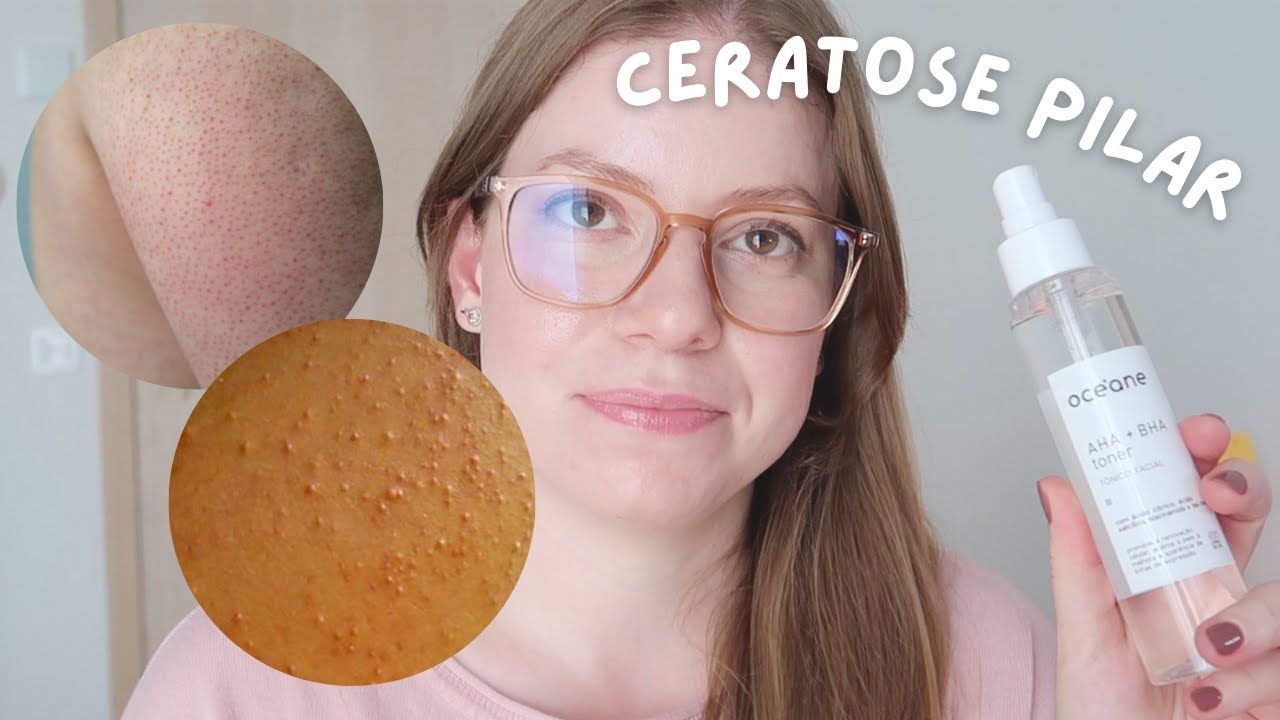 Queratose Pilar: Dicas de Produtos para Tratar em Casa