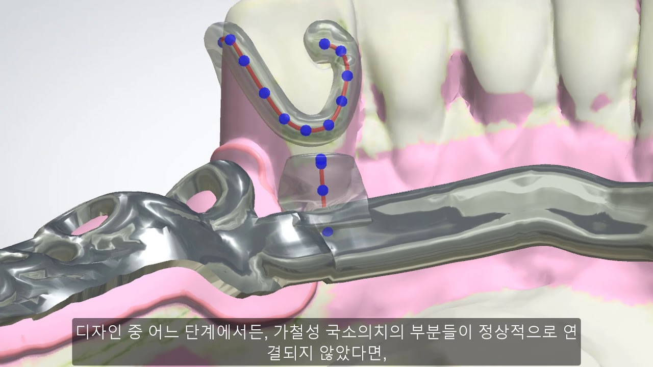 3Shape 덴탈시스템 – RPD 디자인 – 3Shape Dental System – RPD Design
