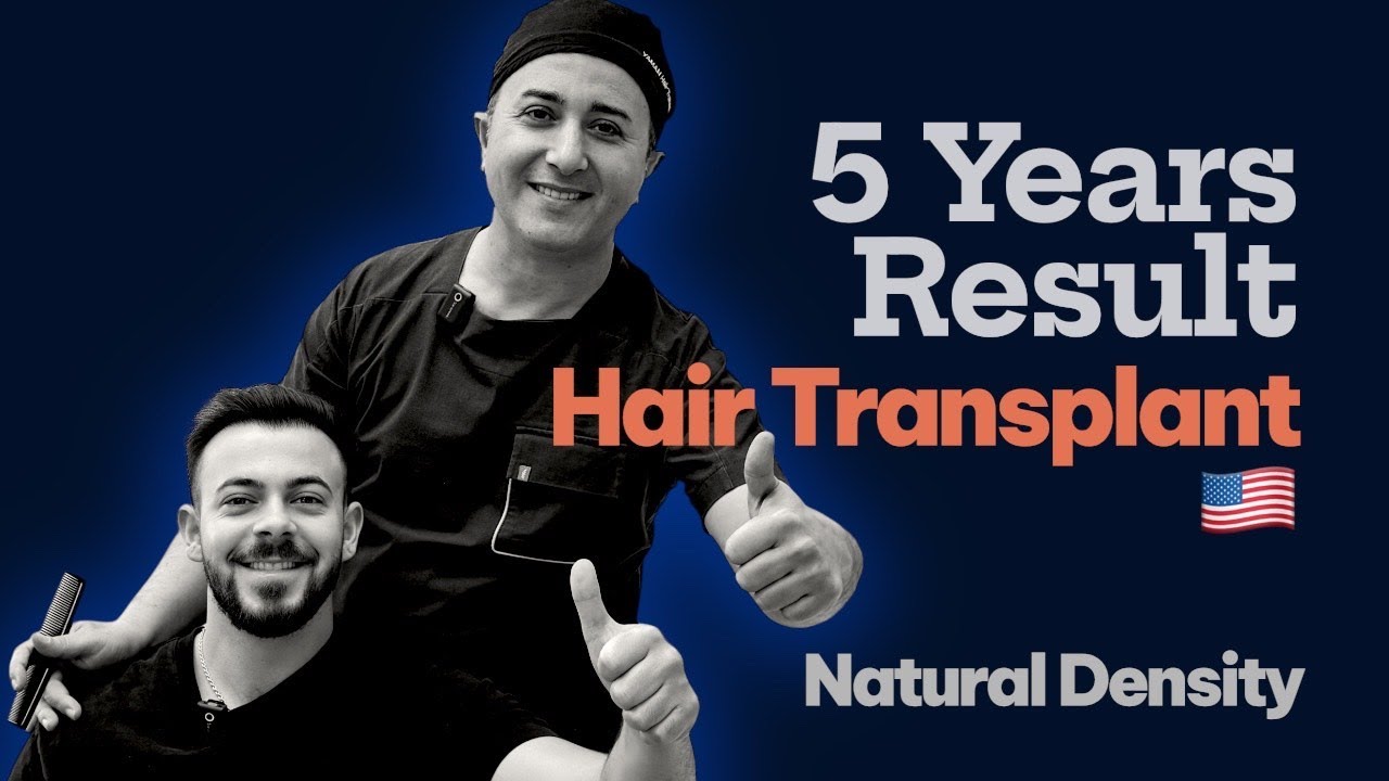 5 Years After Hair Transplant – Natural Density Without Medication - Dr. Resul YAMAN