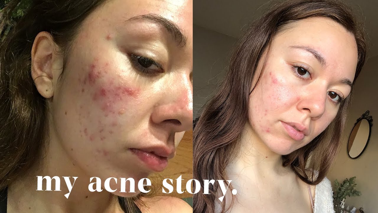 my 10 years of acne struggles... an honest story time