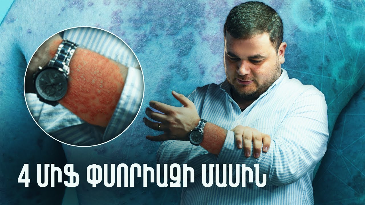 4 Միֆ փսորիազի մասին | #առողջինֆո 57