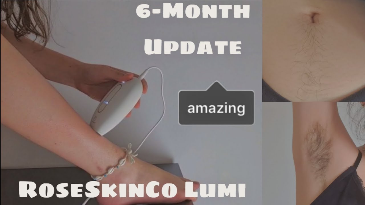 RoseSkinCo Lumi Permanent Hair Removal After 6 Months - Did It Work?