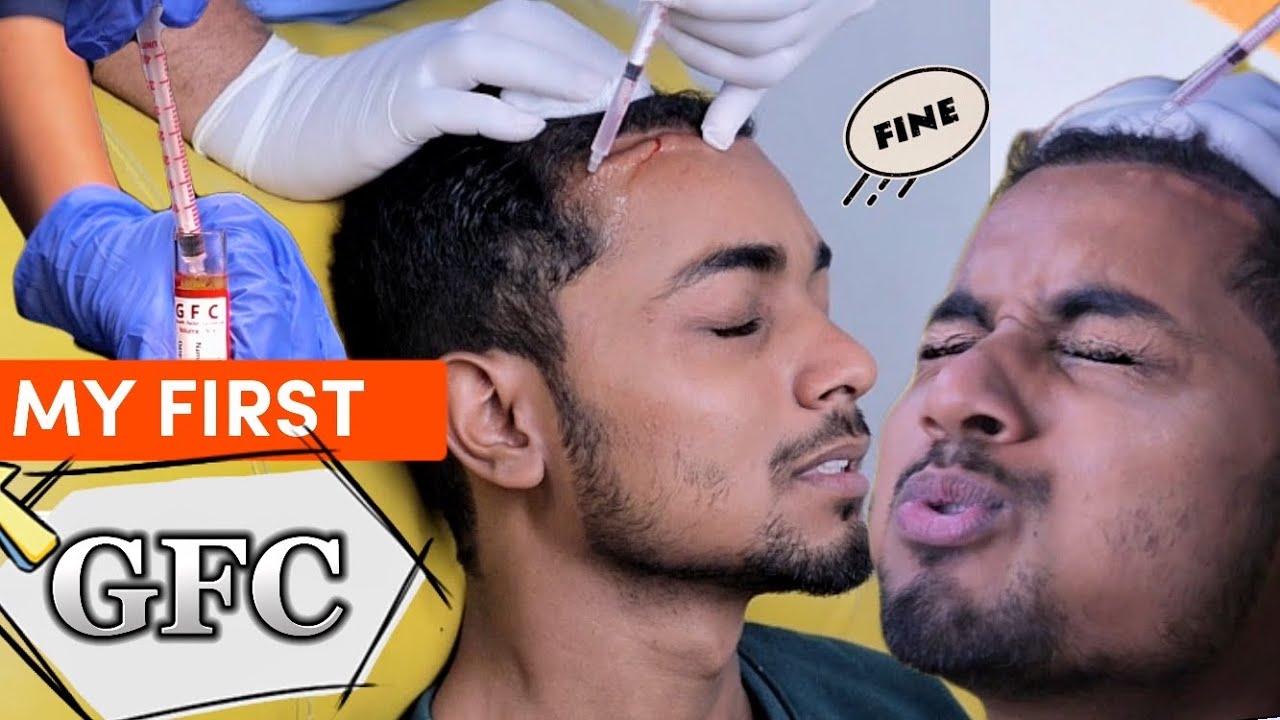 My First GFC Therapy After Hair Transplant | GFC Therapy For Hair Loss | Raj Yadav Hair Transplant