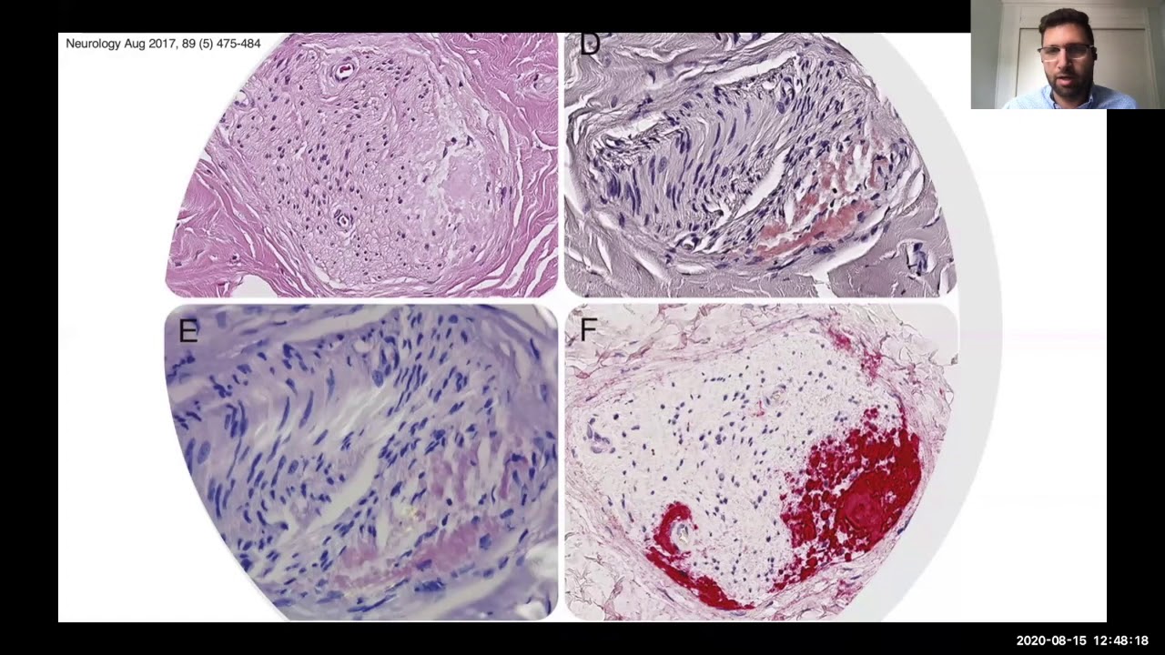Neurological Complications of ATTR Amyloidosis