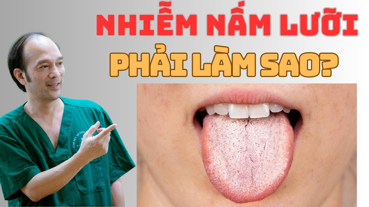 Nhiễm Nấm Lưỡi trong Miệng: Nguyên Nhân, Triệu Chứng và Phương Pháp Điều Trị | Dr Phùng Khoa