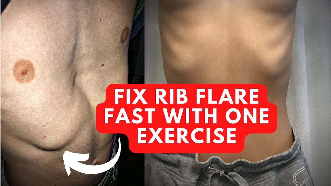 How To Fix Rib Flare With This 1 Powerful Exercise