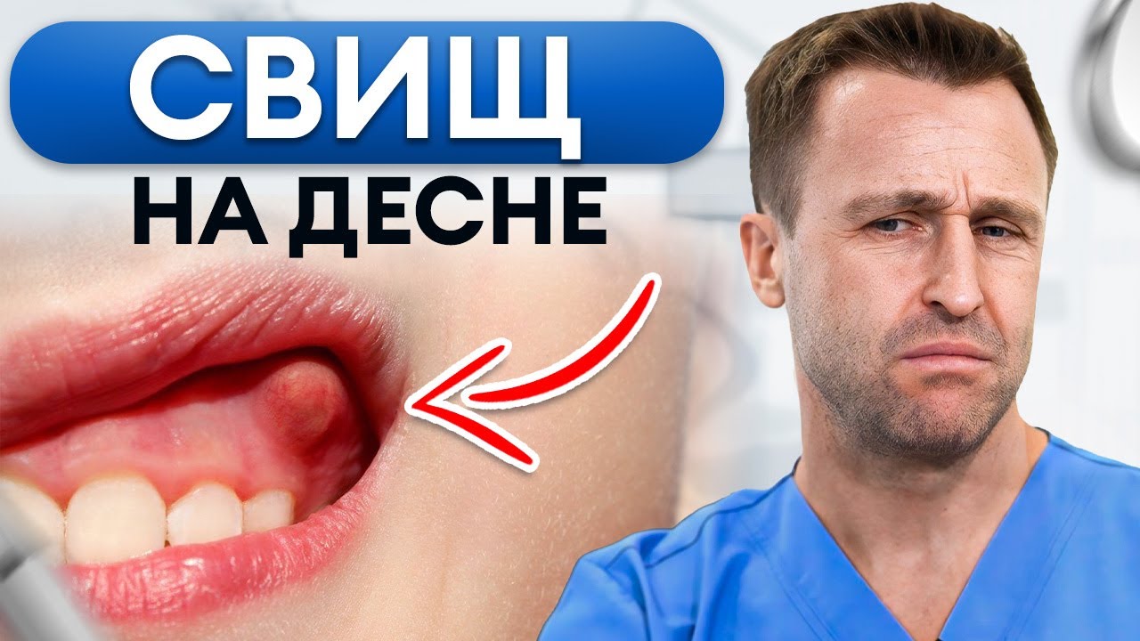 Как опознать и вылечить СВИЩ на десне?