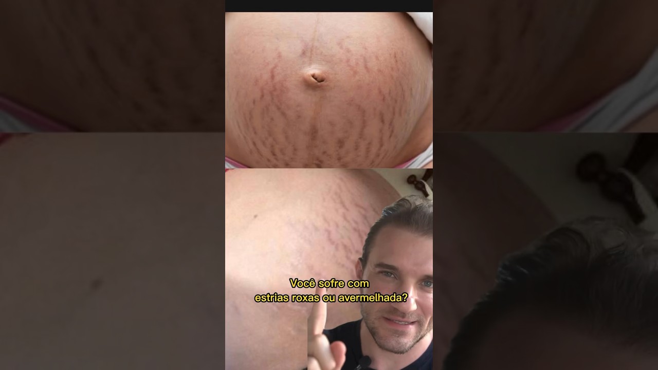 Estrias vermelhas? - dicas de dermatologista